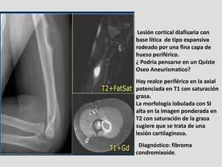 Lesión cortical diafisaria con
base lítica de tipo expansiva
rodeado por una fina capa de
hueso periférico.
¿ Podria pensa...
