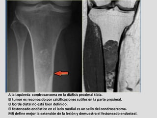 A la izquierda condrosarcoma en la diáfisis proximal tibia.
El tumor es reconocido por calcificaciones sutiles en la parte...
