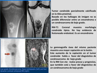 Tumor condroide parcialmente calcificado
 en la tibia proximal.
 Basado en los hallazgos de imágen no es
 posible diferenc...