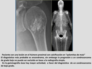 Paciente con una lesión en el húmero proximal con calcificación en “palomitas de maíz”
El diagnóstico más probable es enco...