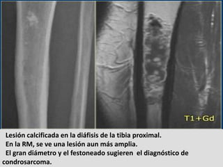 Lesión calcificada en la diáfisis de la tibia proximal.
 En la RM, se ve una lesión aun más amplia.
 El gran diámetro y el...