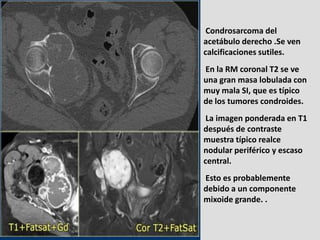 Condrosarcoma del
acetábulo derecho .Se ven
calcificaciones sutiles.
En la RM coronal T2 se ve
una gran masa lobulada con
...