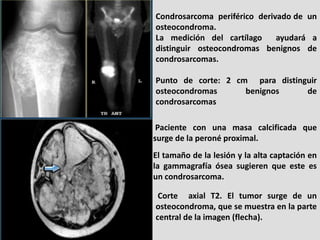 Condrosarcoma periférico derivado de un
osteocondroma.
La medición del cartílago     ayudará a
distinguir osteocondromas b...