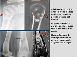 A la izquierda un típico
osteocondroma de base
amplia derivado de la
porción proximal del
húmero.
La mayor parte de la
pro...