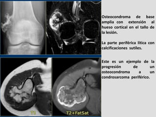 Osteocondroma de base
amplia con extensión al
hueso cortical en el tallo de
la lesión.

La parte periférica lítica con
cal...