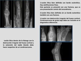 1-Lesión lítica bien definida con borde esclerótico.
                                              Hay calcificaciones fin...