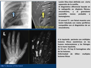 Lesión lítica bien definida con cierta
expansión de la costilla.
El diagnóstico diferencial basado en
la radiografía es: d...