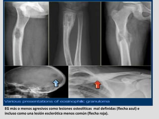 EG más o menos agresivos como lesiones osteolíticas mal definidas (flecha azul) e
incluso como una lesión esclerótica meno...