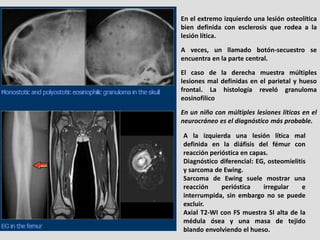 En el extremo izquierdo una lesión osteolítica
bien definida con esclerosis que rodea a la
lesión lítica.
A veces, un llam...