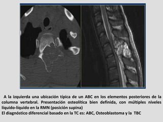 A la izquierda una ubicación típica de un ABC en los elementos posteriores de la
columna vertebral. Presentación osteolíti...