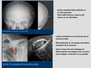 Lesión osteolítica bien definido en
 un niño pequeño.
 Tanto tabla interna y externa del
 cráneo se ven afectados.




Les...