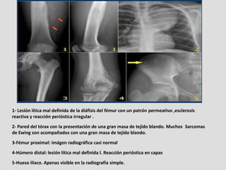 1- Lesión lítica mal definida de la diáfisis del fémur con un patrón permeativo ,esclerosis
reactiva y reacción perióstica...