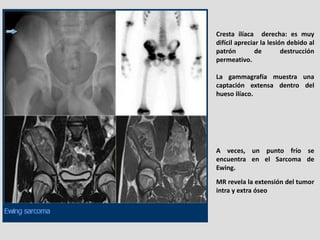 Cresta ilíaca derecha: es muy
difícil apreciar la lesión debido al
patrón         de        destrucción
permeativo.

La ga...