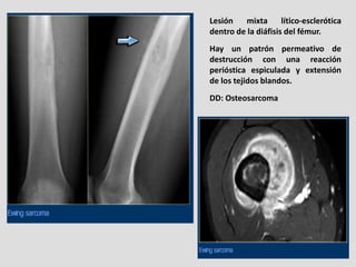 Lesión    mixta      lítico-esclerótica
dentro de la diáfisis del fémur.
Hay un patrón permeativo de
destrucción con una r...