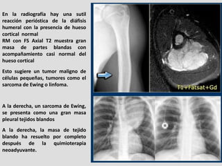 En la radiografía hay una sutil
reacción perióstica de la diáfisis
humeral con la presencia de hueso
cortical normal
RM co...