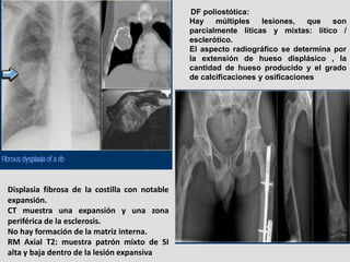 DF poliostótica:
                                               Hay    múltiples    lesiones,   que  son
                 ...