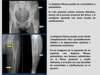 La displasia fibrosa puede ser monostótica o
poliostótica.
En este paciente existen lesiones idénticas,
dentro de la porci...