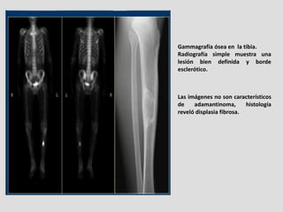 Gammagrafía ósea en la tibia.
Radiografía simple muestra una
lesión bien definida y borde
esclerótico.



Las imágenes no ...