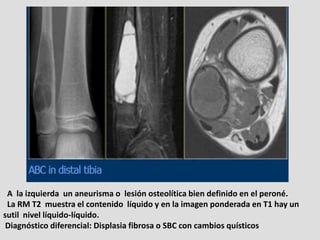 A la izquierda un aneurisma o lesión osteolítica bien definido en el peroné.
 La RM T2 muestra el contenido líquido y en l...