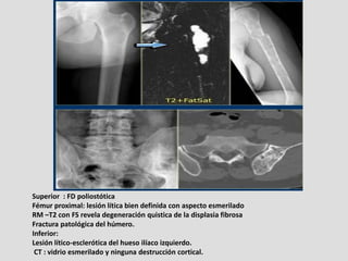 Superior : FD poliostótica
Fémur proximal: lesión lítica bien definida con aspecto esmerilado
RM –T2 con FS revela degener...