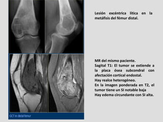 Lesión excéntrica lítica en la
metáfisis del fémur distal.




MR del mismo paciente.
Sagital T1: El tumor se extiende a
l...