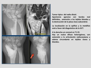 Tumor típico del radio distal:
Apariencia agresiva con bordes mal
definidos, extensión a los tejidos blandos y
la destrucc...