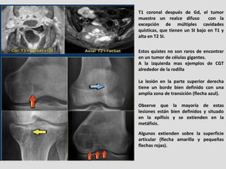 T1 coronal después de Gd, el tumor
muestra un realce difuso         con la
excepción de múltiples cavidades
quísticas, que...