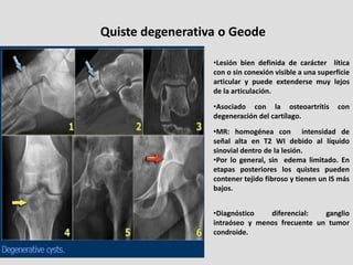 Quiste degenerativa o Geode

                  •Lesión bien definida de carácter lítica
                  con o sin conexi...