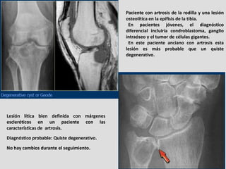 Paciente con artrosis de la rodilla y una lesión
                                             osteolítica en la epífisis d...