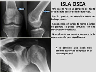 ISLA OSEA
 Una isla de hueso se compone de tejido
óseo maduro dentro de la médula ósea.
 Por lo general, se considera como...
