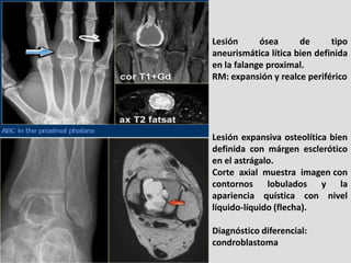 Lesión      ósea      de      tipo
aneurismática lítica bien definida
en la falange proximal.
RM: expansión y realce perif...