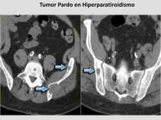 Tumor Pardo en Hiperparatiroidismo
 