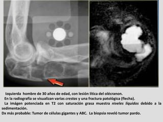 Izquierda hombre de 30 años de edad, con lesión lítica del olécranon.
  En la radiografía se visualizan varias crestas y u...
