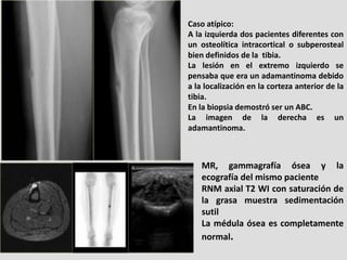 Caso atípico:
A la izquierda dos pacientes diferentes con
un osteolítica intracortical o subperosteal
bien definidos de la...
