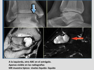 A la izquierda, otro ABC en el astrágalo.
Apenas visible en las radiografías
MR muestra típicos niveles liquido- liquido
 