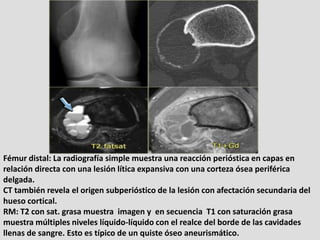 Fémur distal: La radiografía simple muestra una reacción perióstica en capas en
relación directa con una lesión lítica exp...
