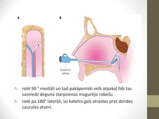 A. rotē 90 ° mediāli un tad pakāpeniski velk atpakaļ līdz tas
sasniedz deguna starpsienas mugurējo robežu.
B. rotē pa 180° laterāli, lai katetra gals atrastos pret dzirdes
caurules atveri.

 