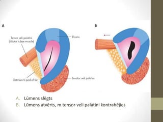 A. Lūmens slēgts
B. Lūmens atvērts, m.tensor veli palatini kontrahējies

 