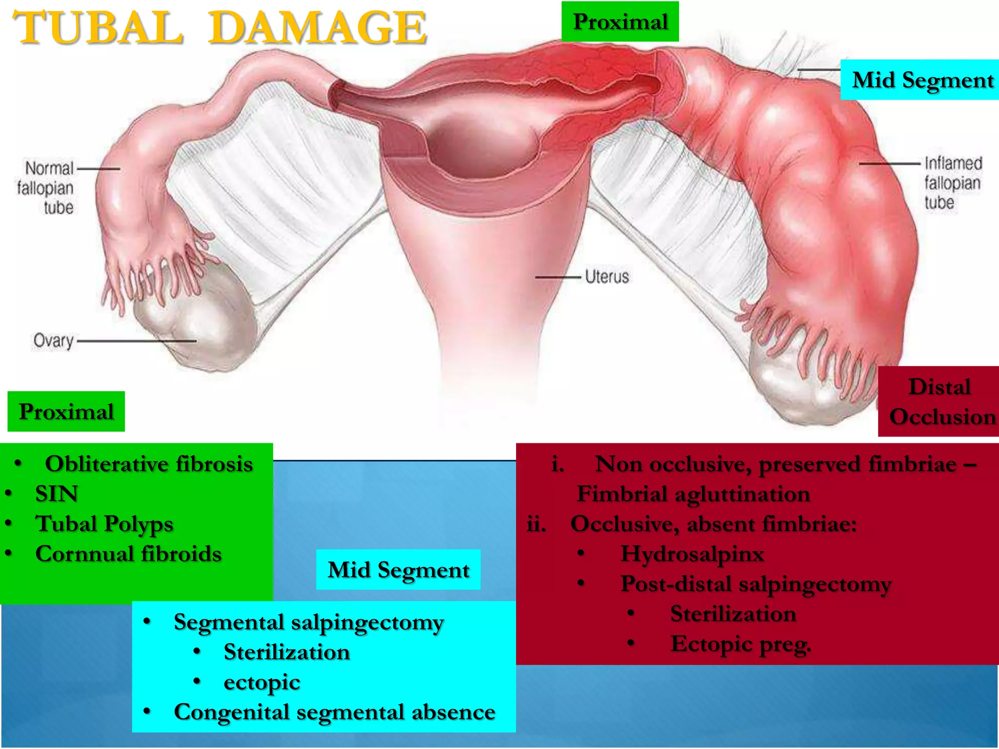 Patss Tubal surgery vs. Assisted Reproductive Technologies (ART) | PDF