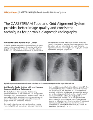 White Paper | CARESTREAM DRX-Revolution Mobile X-ray System
The CARESTREAM Tube and Grid Alignment System
provides better image quality and consistent
techniques for portable diagnostic radiography
Anti-Scatter Grids Improve Image Quality
Scattered radiation is a major contributor to reduced image
quality in diagnostic radiography. Anti-scatter grids, when
properly aligned, provide an effective means for reducing
scatter [1-6]. The preferential transmission of primary versus
scattered X-rays improves the contrast-to-noise ratio (CNR).
Figure 1 shows a pair of portable chest images captured of an
ICU patient with and without grids and under the same
exposure conditions. Comparing the two images, the contrast
improvement with grids is significant.
Figure 1 -- Comparison of portable chest images captured of an ICU patient without (left) and with (right) anti-scatter grid
Grid Benefits Can be Realized with Less Exposure
Increments in Digital Radiography
The Bucky factor is the reciprocal of the total X-ray
penetration through an anti-scatter grid. The analog screen-
film system has a fixed sensitometry response. When a grid is
used, a Bucky factor technique increment was necessary to
ensure sufficient exposure to produce a film image with
proper density and contrast for diagnosis.
The benefits of anti-scatter grids can be realized in digital
radiography (DR) with less exposure technique increments
than would be indicated by traditional Bucky factors [7]. This
is because DR does not have a fixed sensitomety response;
the global contrast and brightness of a DR image can be
arbitrarily modified by digital image processing. DR systems
are fundamentally noise limited – within a broad range of
exposure levels to the patient, the image quality is
determined by the anatomy CNR in the captured image.
Anti-scatter grids can improve the image CNR at a minor
expense of reduced primary X-ray transmission. This suggests
some exposure technique increase may be required to
compensate for primary X-ray attenuation, but usually at a
lower level than the Bucky factor.
 