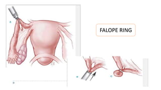 Tubectomy, Non Scalpel Vasectomy ( sterilization) | PPTX
