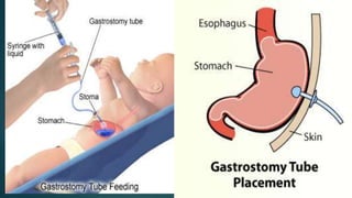 View of Tube feeding ( Gavage feeding ) | PPTX