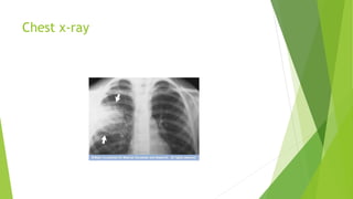 Chest x-ray
 