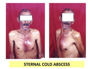 STERNAL COLD ABSCESS
 