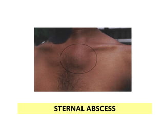 STERNAL ABSCESS
 