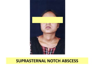 SUPRASTERNAL NOTCH ABSCESS
 