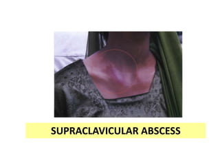 SUPRACLAVICULAR ABSCESS
 