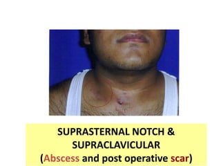 SUPRASTERNAL NOTCH &
SUPRACLAVICULAR
(Abscess and post operative scar)
 
