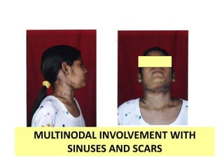MULTINODAL INVOLVEMENT WITH
SINUSES AND SCARS
 