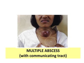 MULTIPLE ABSCESS
(with communicating tract)
 